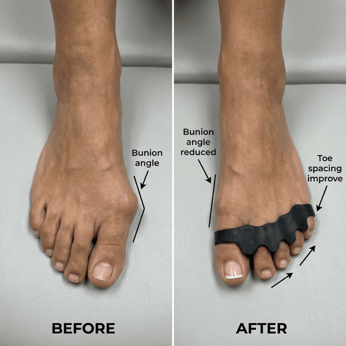 BareStep Allign™ Medical - Grade Silicone - BareStep